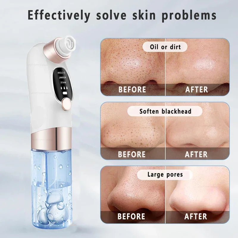Pore Clean Blackhead Vacuum